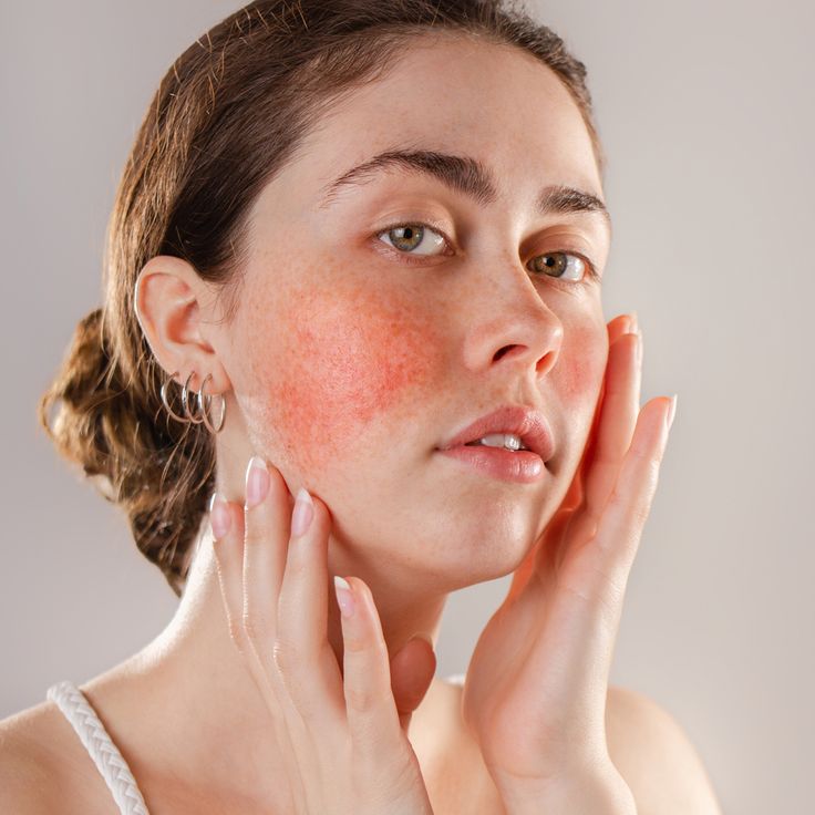 Acne & Rosacea