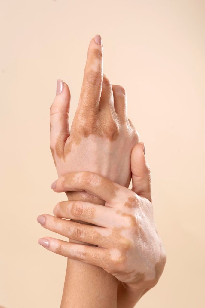 Pigmentation & Vitiligo