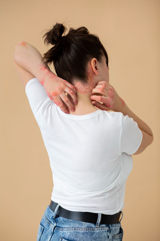 Psoriasis & Eczema